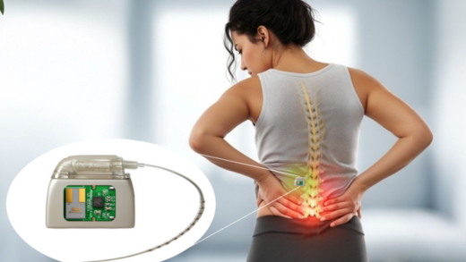 Neuromodulation Use Case Image