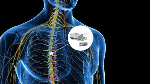 Disruptive Product Design in Neuromodulation